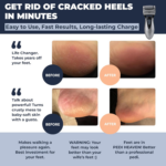 Electric Foot Callus Remover - Rechargeable Pedicure File Tool - Image 2