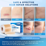 Silicone Scar Sheets, Silicone Scar Tape(1.8” X 157” Roll 4M) - Image 4